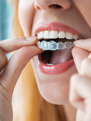 invisalign info